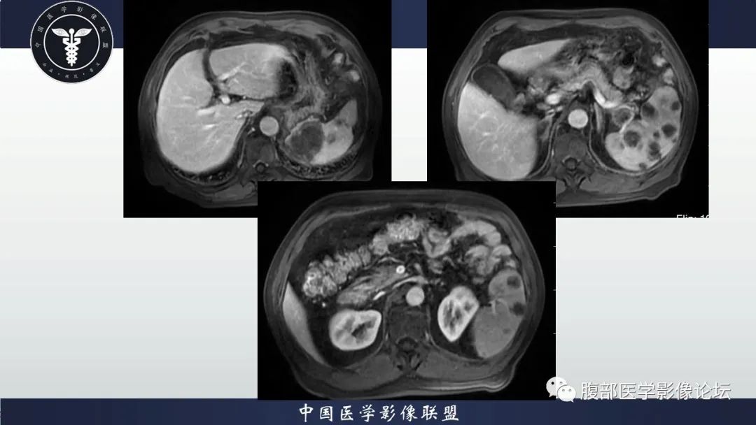 【病例】脾脏弥漫性大B细胞淋巴瘤1例MR影像讨论
