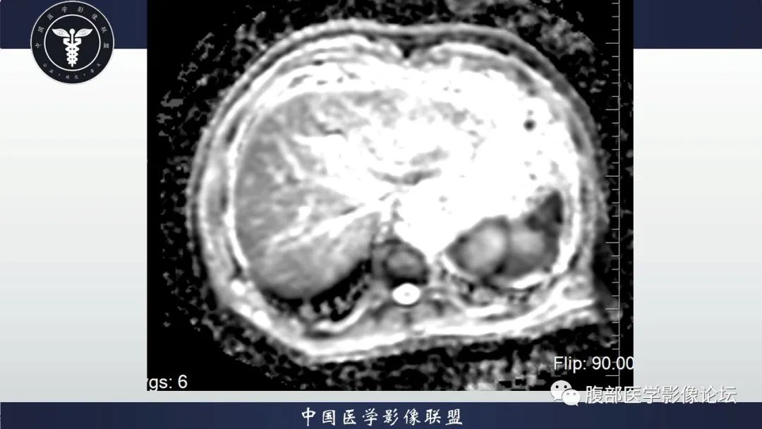 【病例】脾脏弥漫性大B细胞淋巴瘤1例MR影像讨论