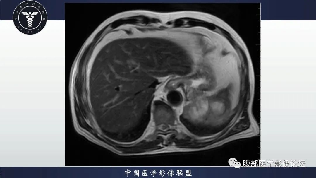 【病例】脾脏弥漫性大B细胞淋巴瘤1例MR影像讨论