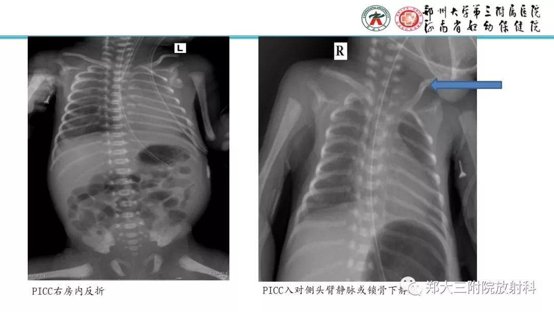 【PPT】新生儿床边胸片解读与置管评价