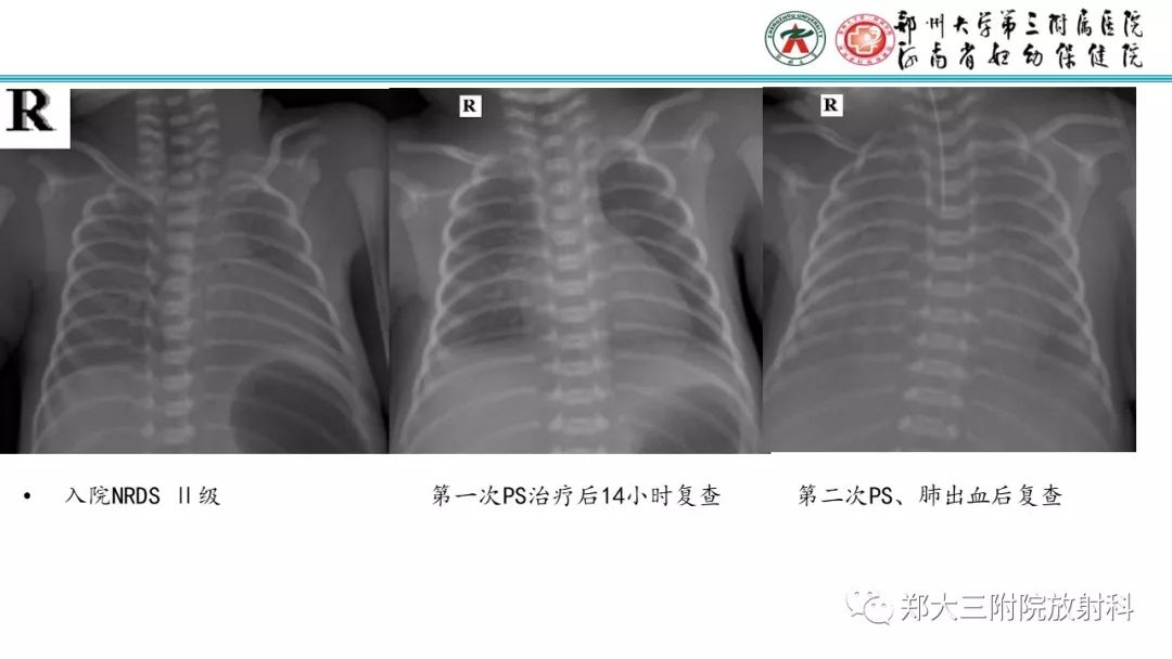 【PPT】新生儿床边胸片解读与置管评价
