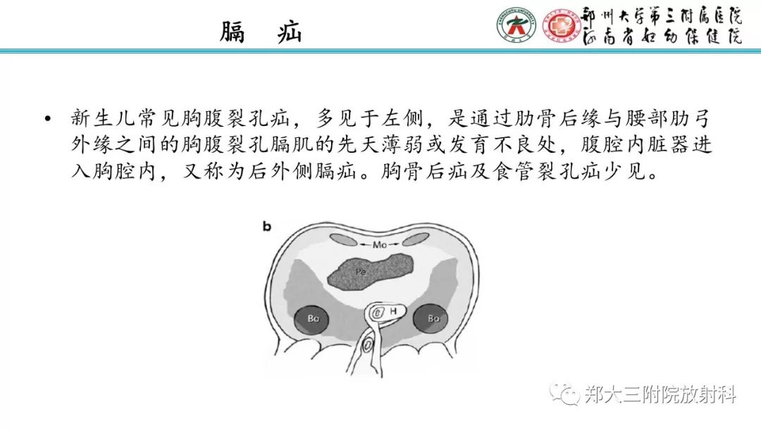 【PPT】新生儿床边胸片解读与置管评价