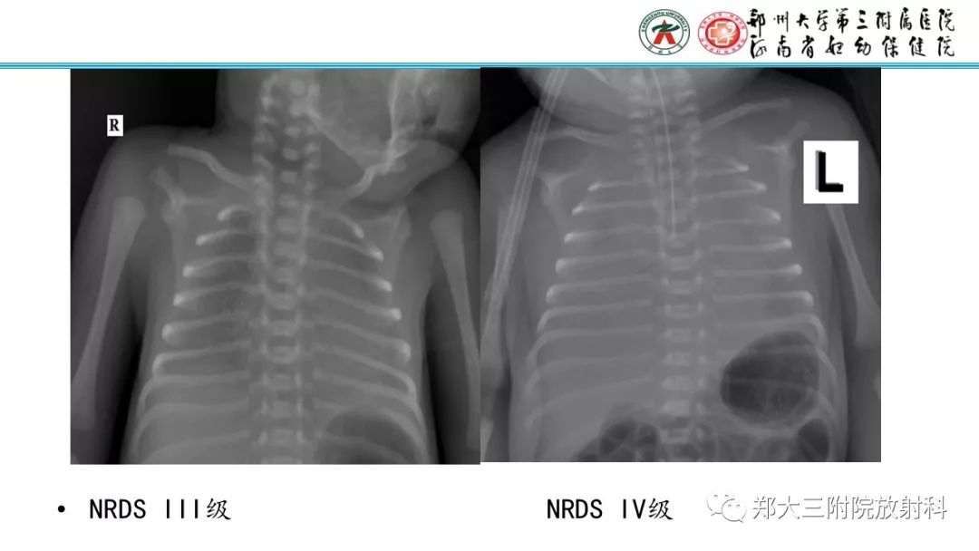 【PPT】新生儿床边胸片解读与置管评价