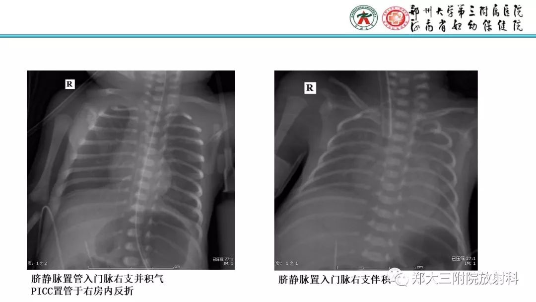【PPT】新生儿床边胸片解读与置管评价