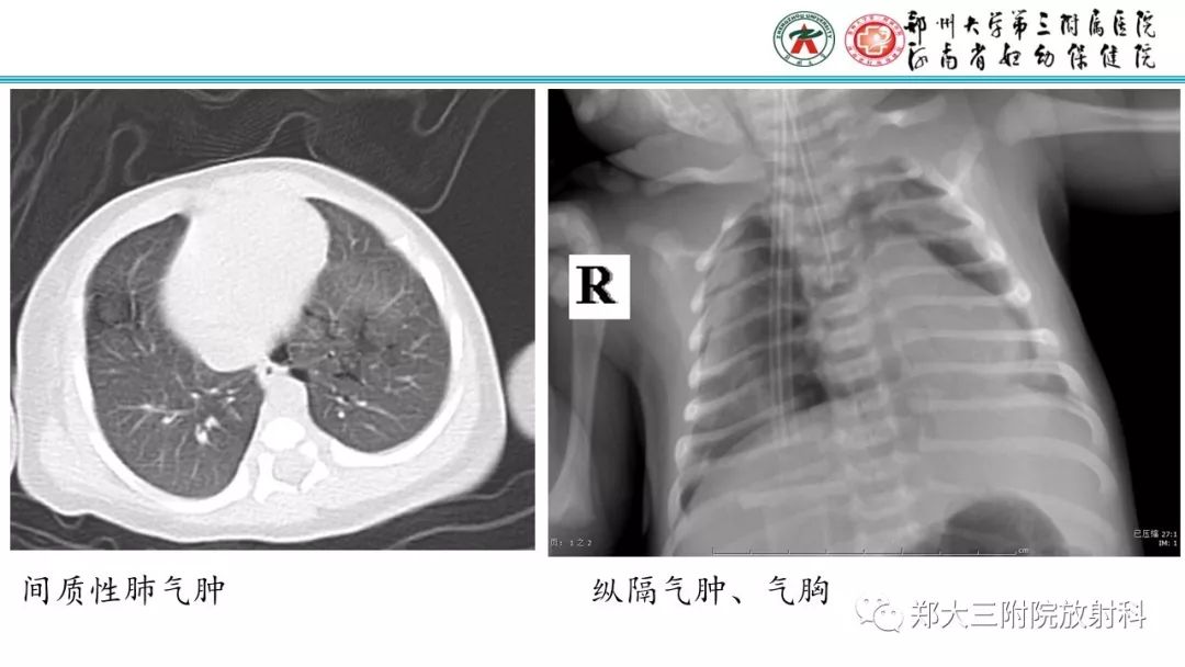 【PPT】新生儿床边胸片解读与置管评价