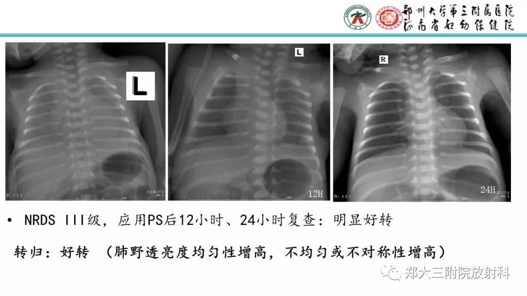 【PPT】新生儿床边胸片解读与置管评价