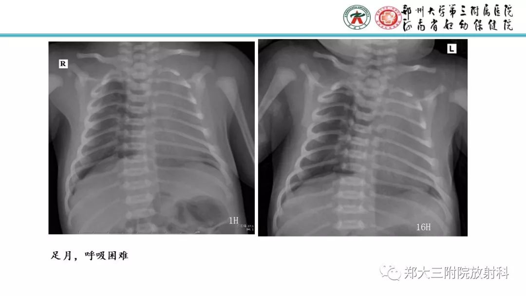 【PPT】新生儿床边胸片解读与置管评价