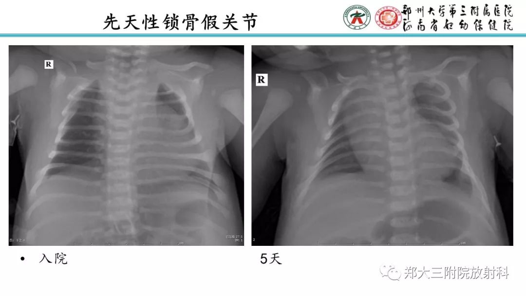 【PPT】新生儿床边胸片解读与置管评价