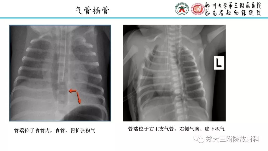 【PPT】新生儿床边胸片解读与置管评价