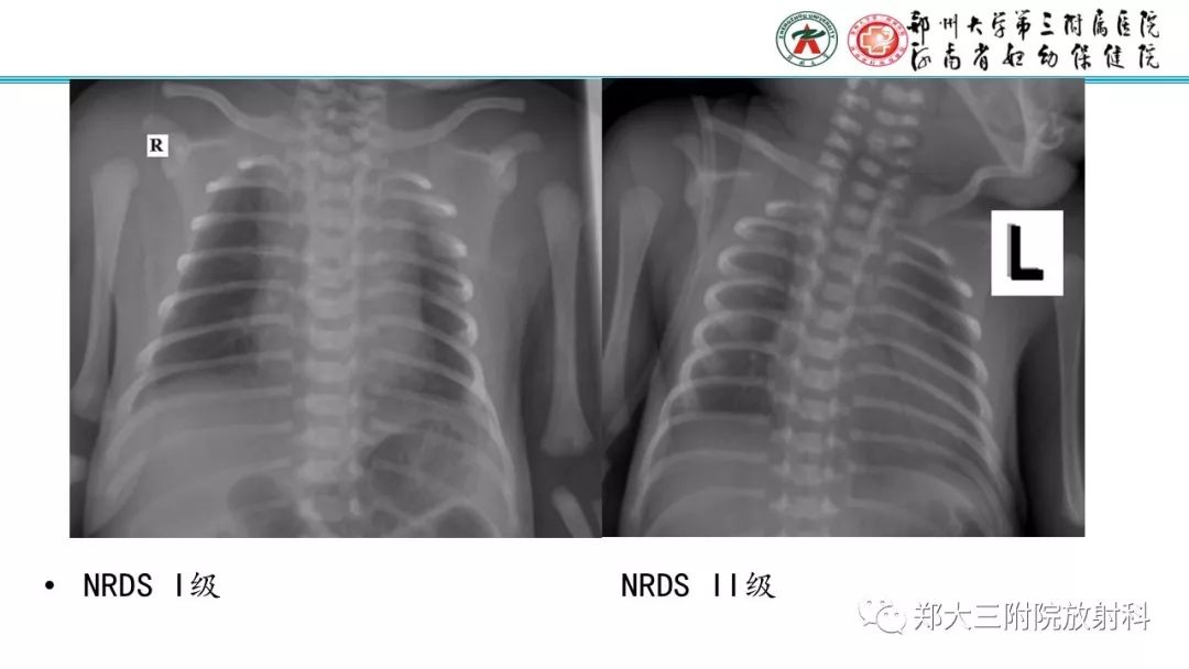 【PPT】新生儿床边胸片解读与置管评价
