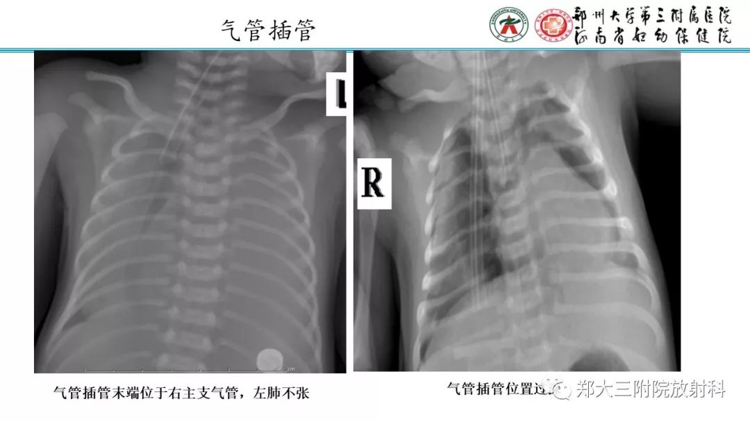 【PPT】新生儿床边胸片解读与置管评价