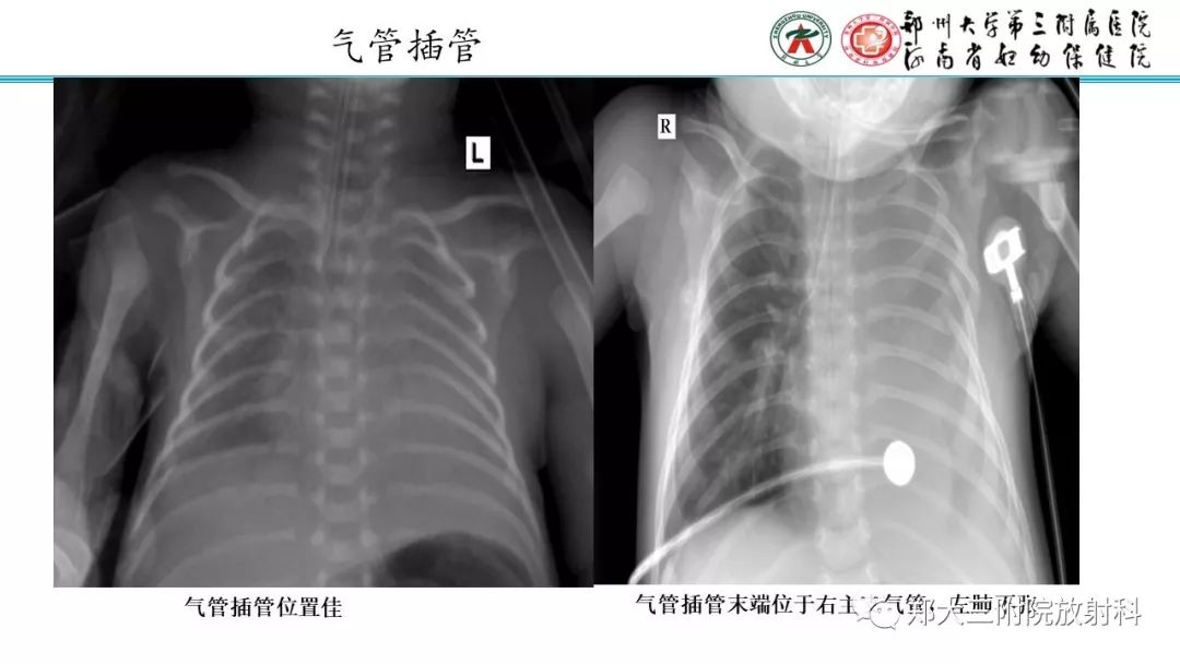【PPT】新生儿床边胸片解读与置管评价