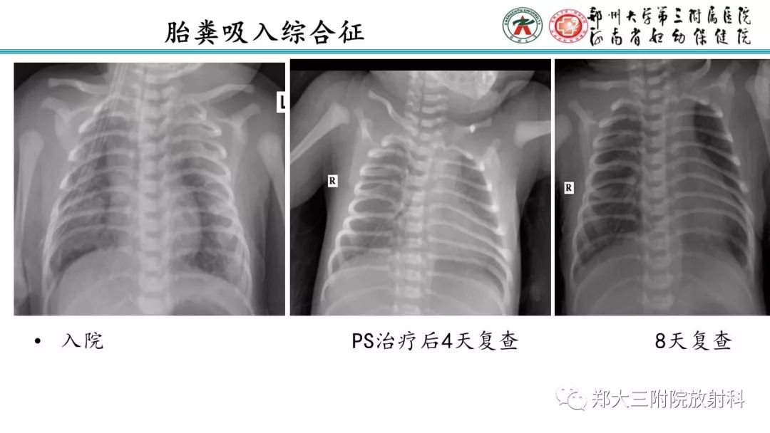 【PPT】新生儿床边胸片解读与置管评价