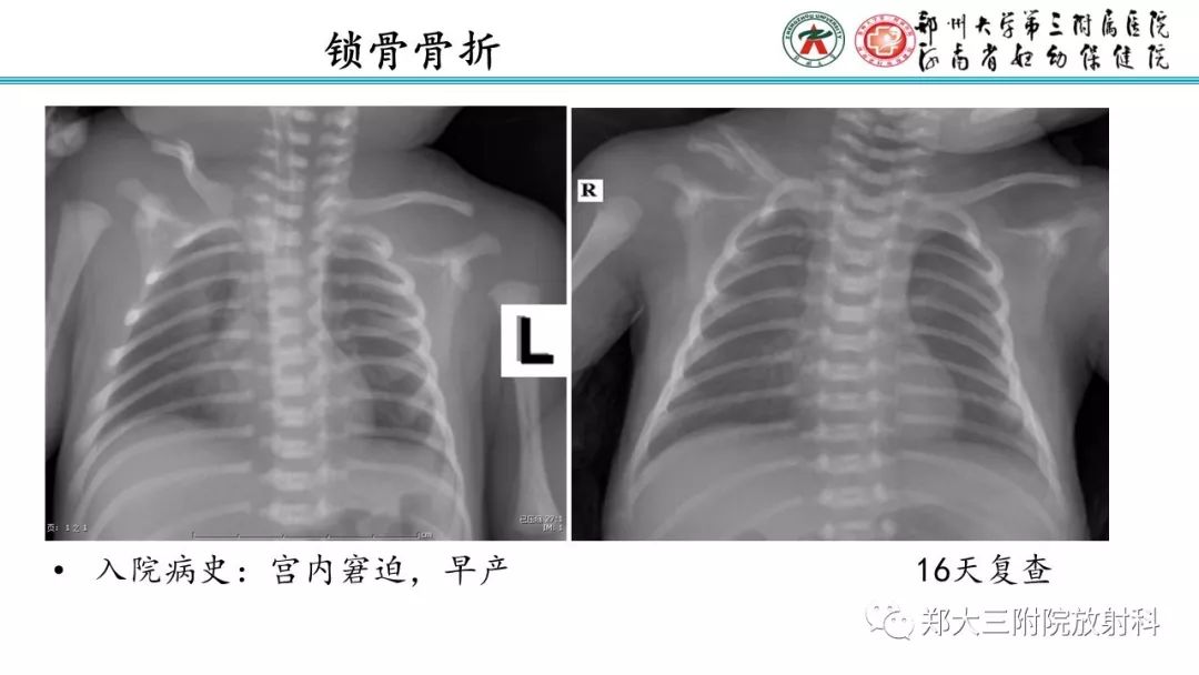 【PPT】新生儿床边胸片解读与置管评价