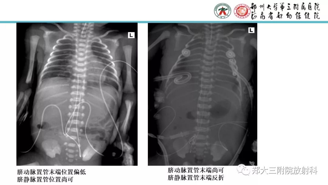 【PPT】新生儿床边胸片解读与置管评价
