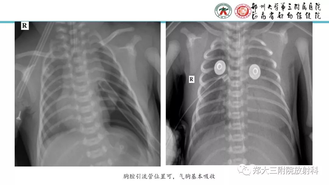 【PPT】新生儿床边胸片解读与置管评价