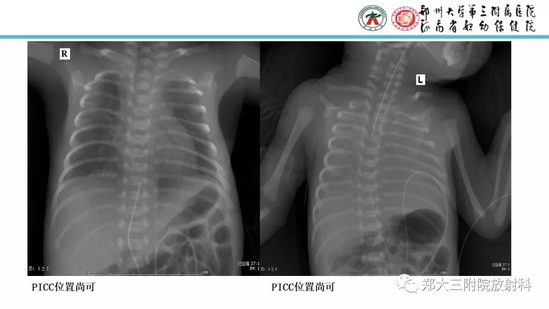【PPT】新生儿床边胸片解读与置管评价