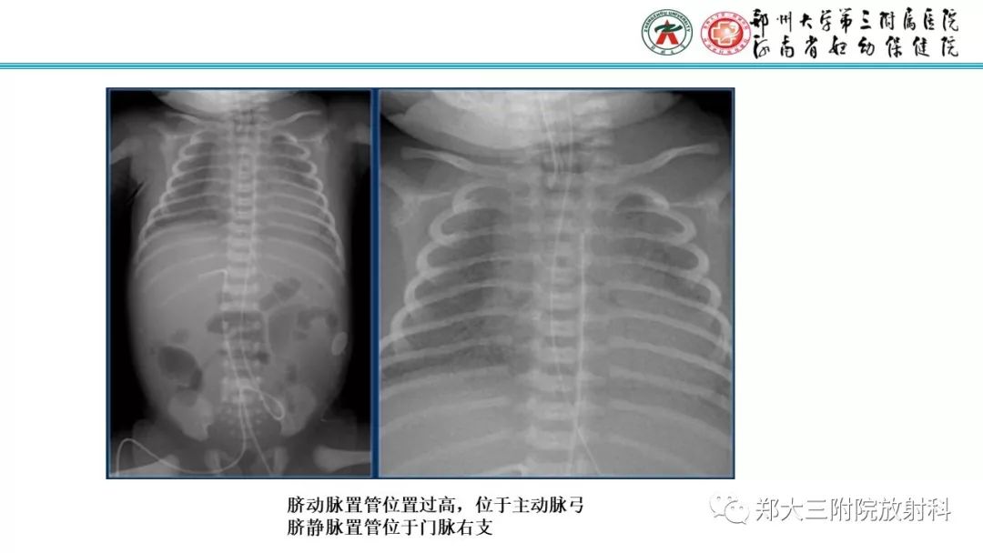 【PPT】新生儿床边胸片解读与置管评价