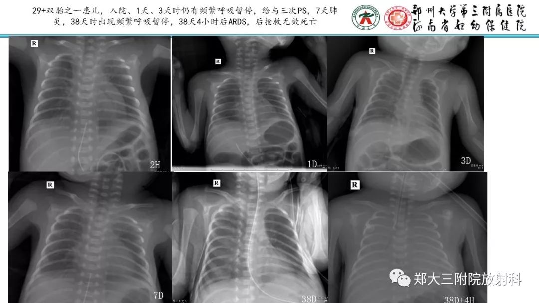 【PPT】新生儿床边胸片解读与置管评价