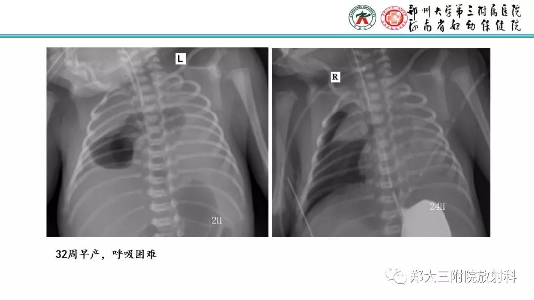 【PPT】新生儿床边胸片解读与置管评价