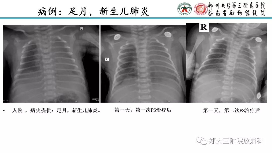 【PPT】新生儿床边胸片解读与置管评价