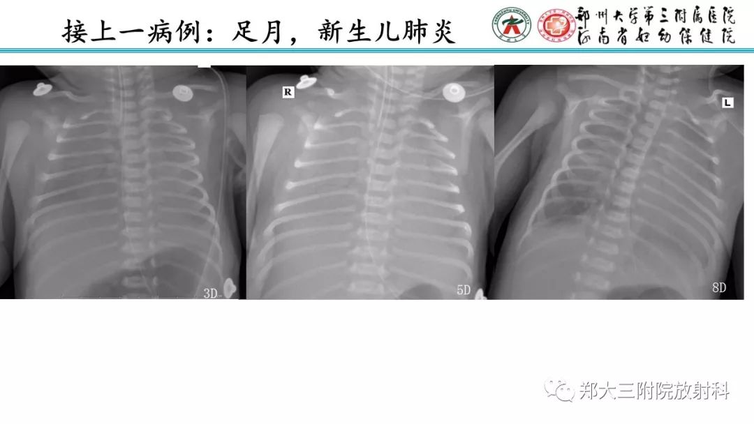 【PPT】新生儿床边胸片解读与置管评价