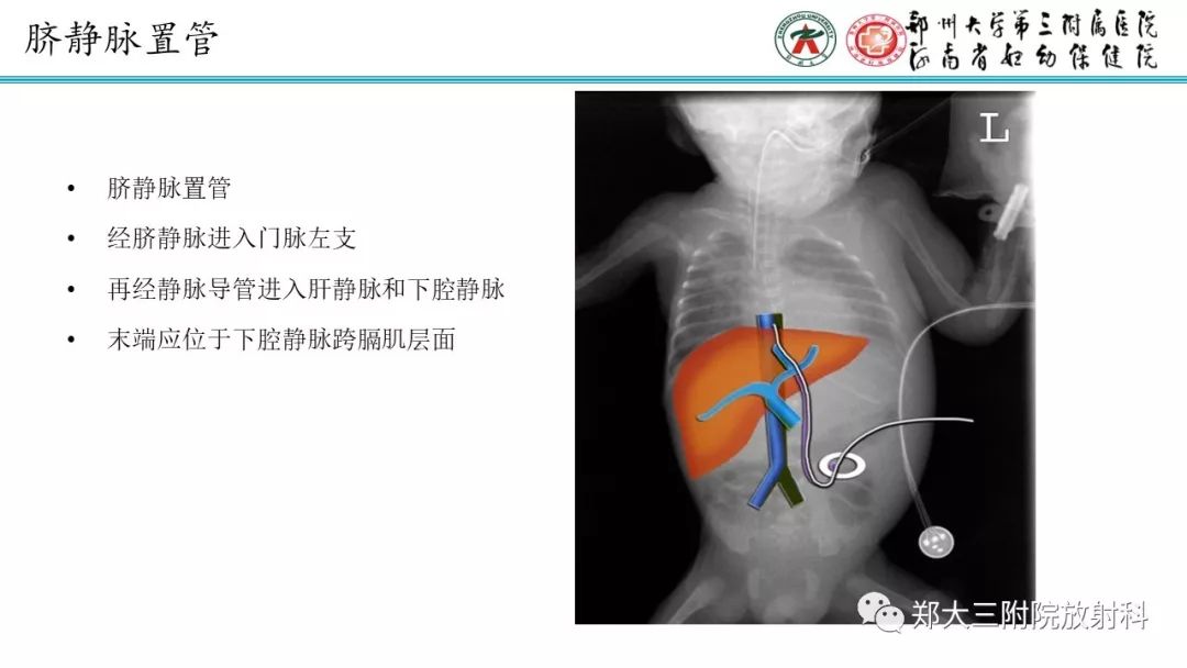 【PPT】新生儿床边胸片解读与置管评价