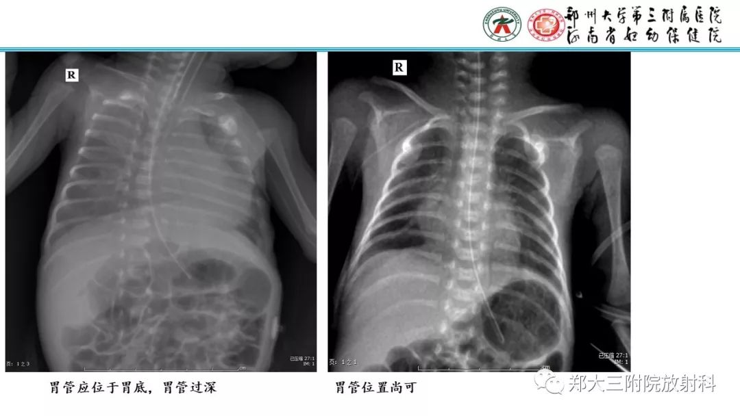 【PPT】新生儿床边胸片解读与置管评价