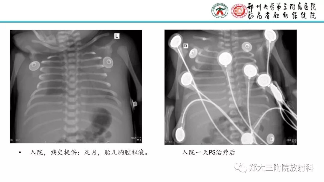 【PPT】新生儿床边胸片解读与置管评价