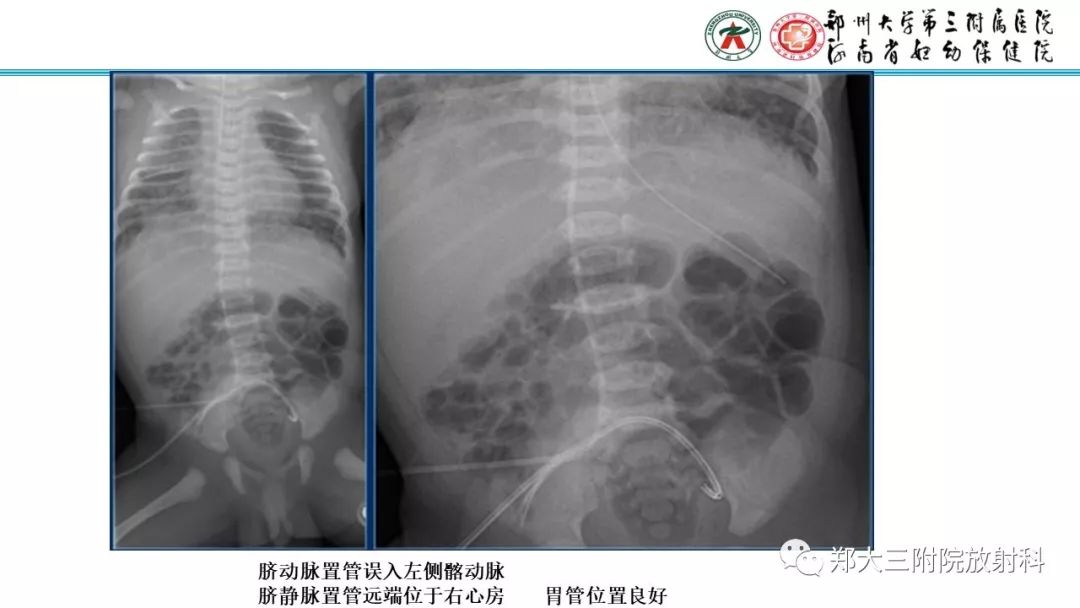 【PPT】新生儿床边胸片解读与置管评价