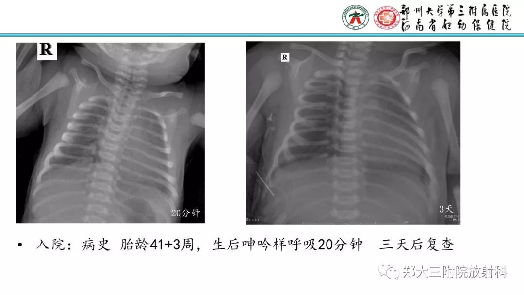 【PPT】新生儿床边胸片解读与置管评价