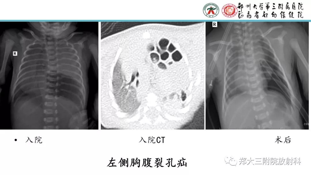 【PPT】新生儿床边胸片解读与置管评价
