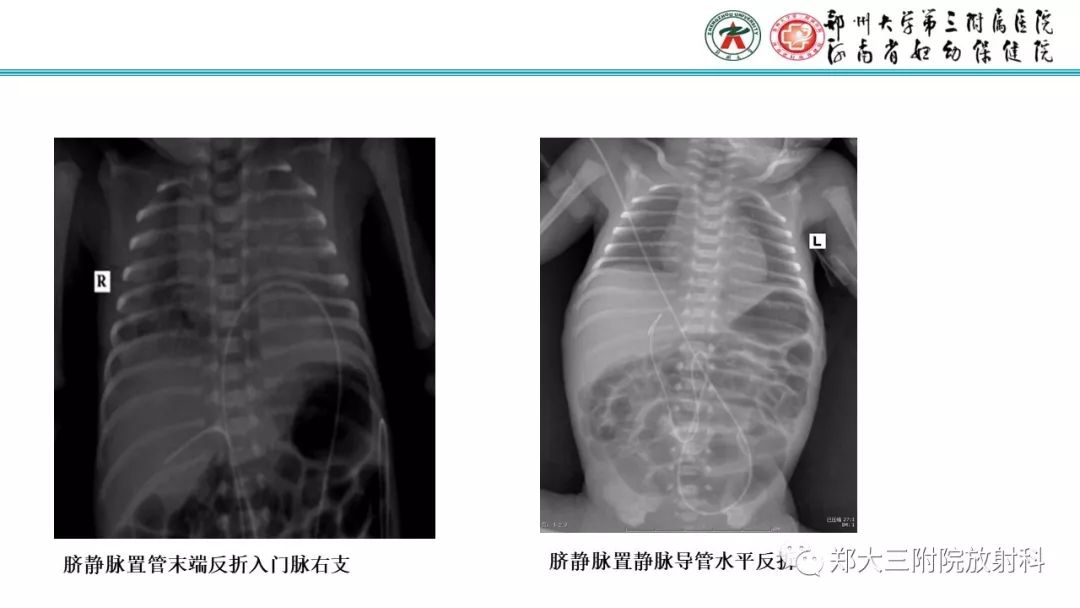 【PPT】新生儿床边胸片解读与置管评价