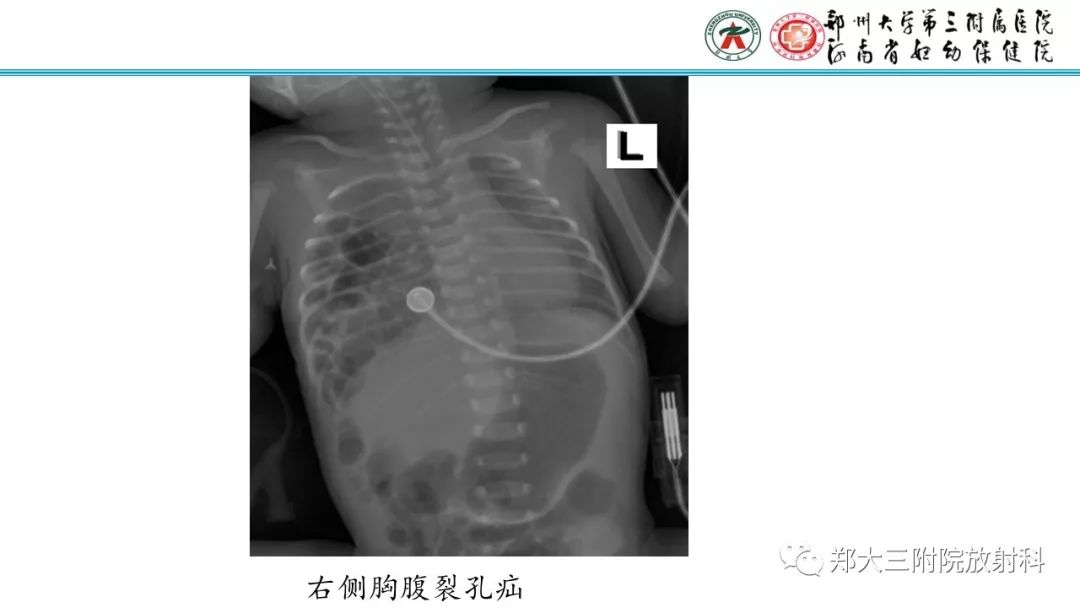 【PPT】新生儿床边胸片解读与置管评价