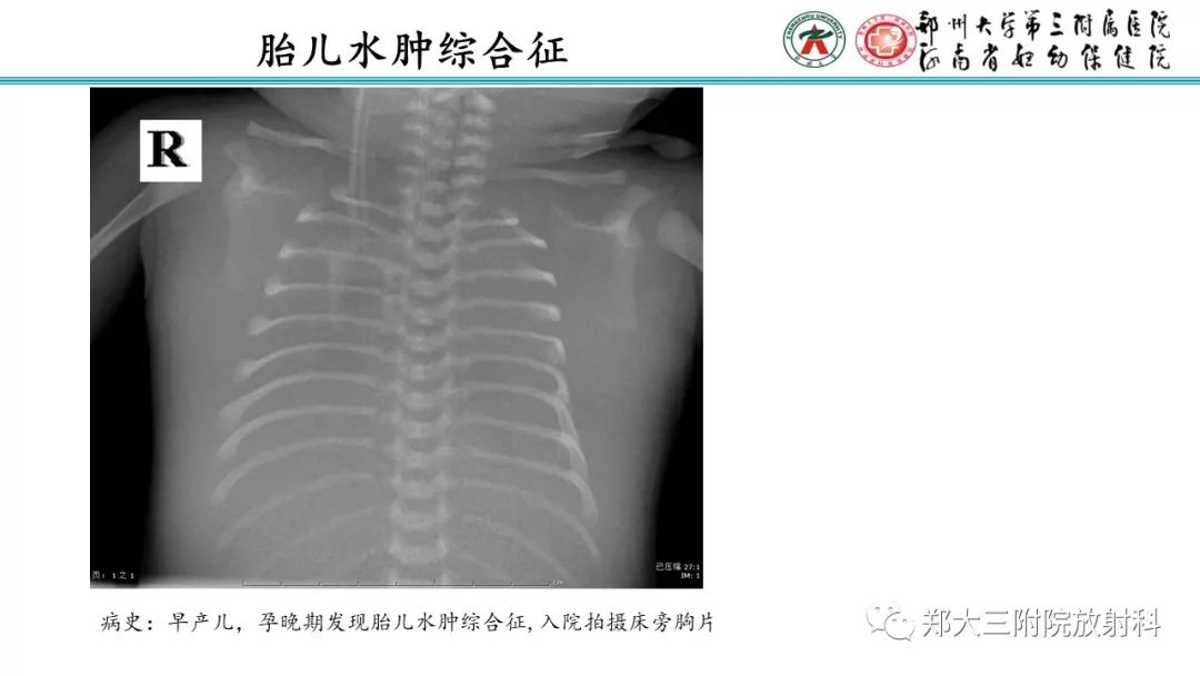 【PPT】新生儿床边胸片解读与置管评价