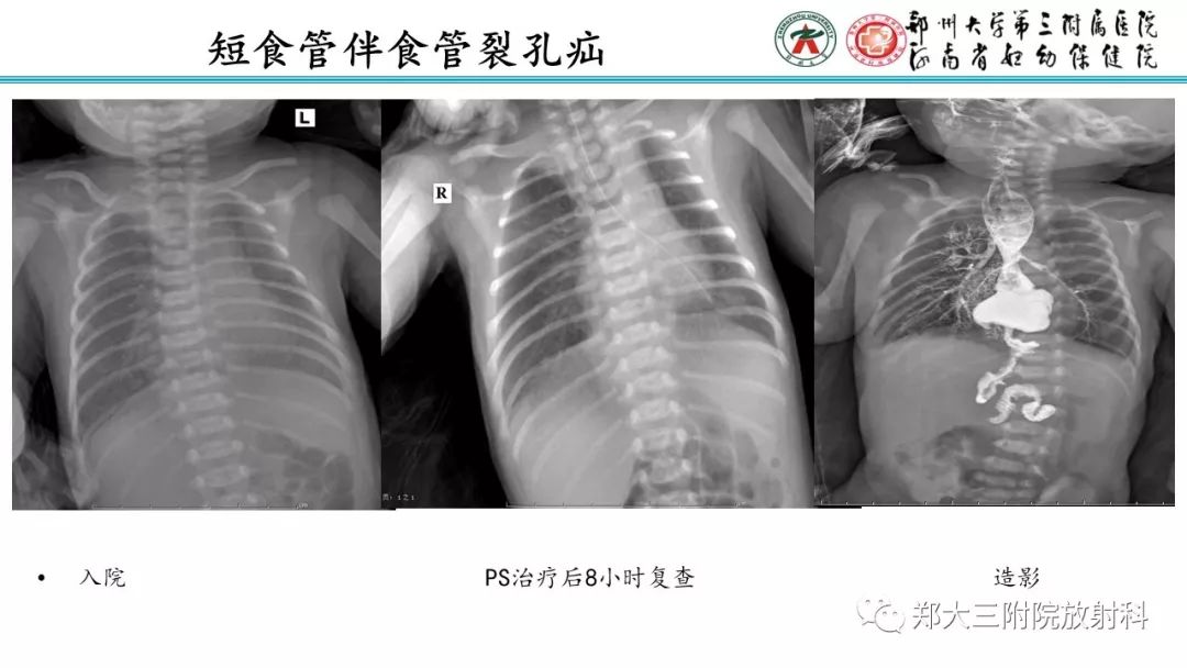 【PPT】新生儿床边胸片解读与置管评价