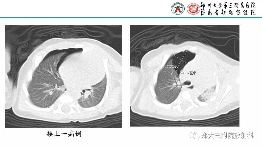 【PPT】新生儿床边胸片解读与置管评价