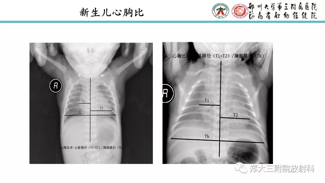 【PPT】新生儿床边胸片解读与置管评价