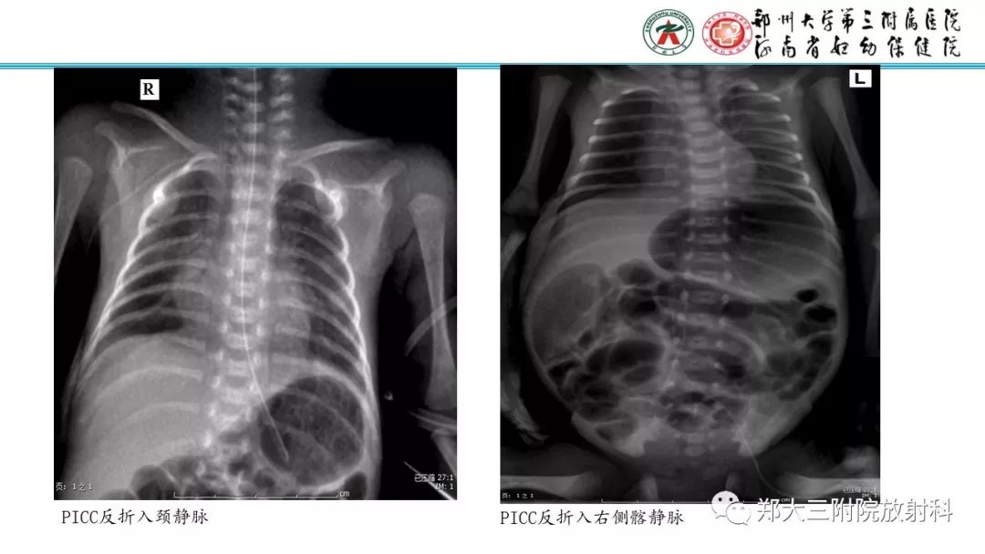 【PPT】新生儿床边胸片解读与置管评价