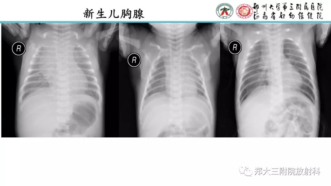 【PPT】新生儿床边胸片解读与置管评价