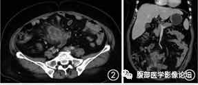 腹腔局灶性脂肪坏死的典型影像学征象及其鉴别诊断