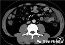 腹腔局灶性脂肪坏死的典型影像学征象及其鉴别诊断