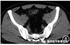 腹腔局灶性脂肪坏死的典型影像学征象及其鉴别诊断