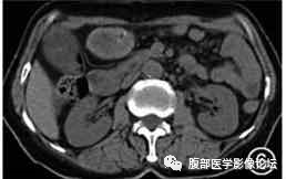腹腔局灶性脂肪坏死的典型影像学征象及其鉴别诊断