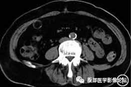 腹腔局灶性脂肪坏死的典型影像学征象及其鉴别诊断