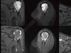 肱骨软骨母细胞瘤影像诊断