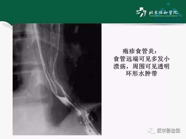 【PPT】艾滋病相关消化道影像学表现