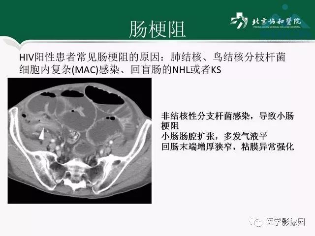 【PPT】艾滋病相关消化道影像学表现