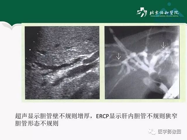 【PPT】艾滋病相关消化道影像学表现