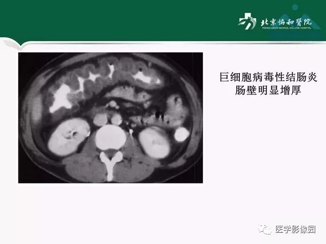 【PPT】艾滋病相关消化道影像学表现